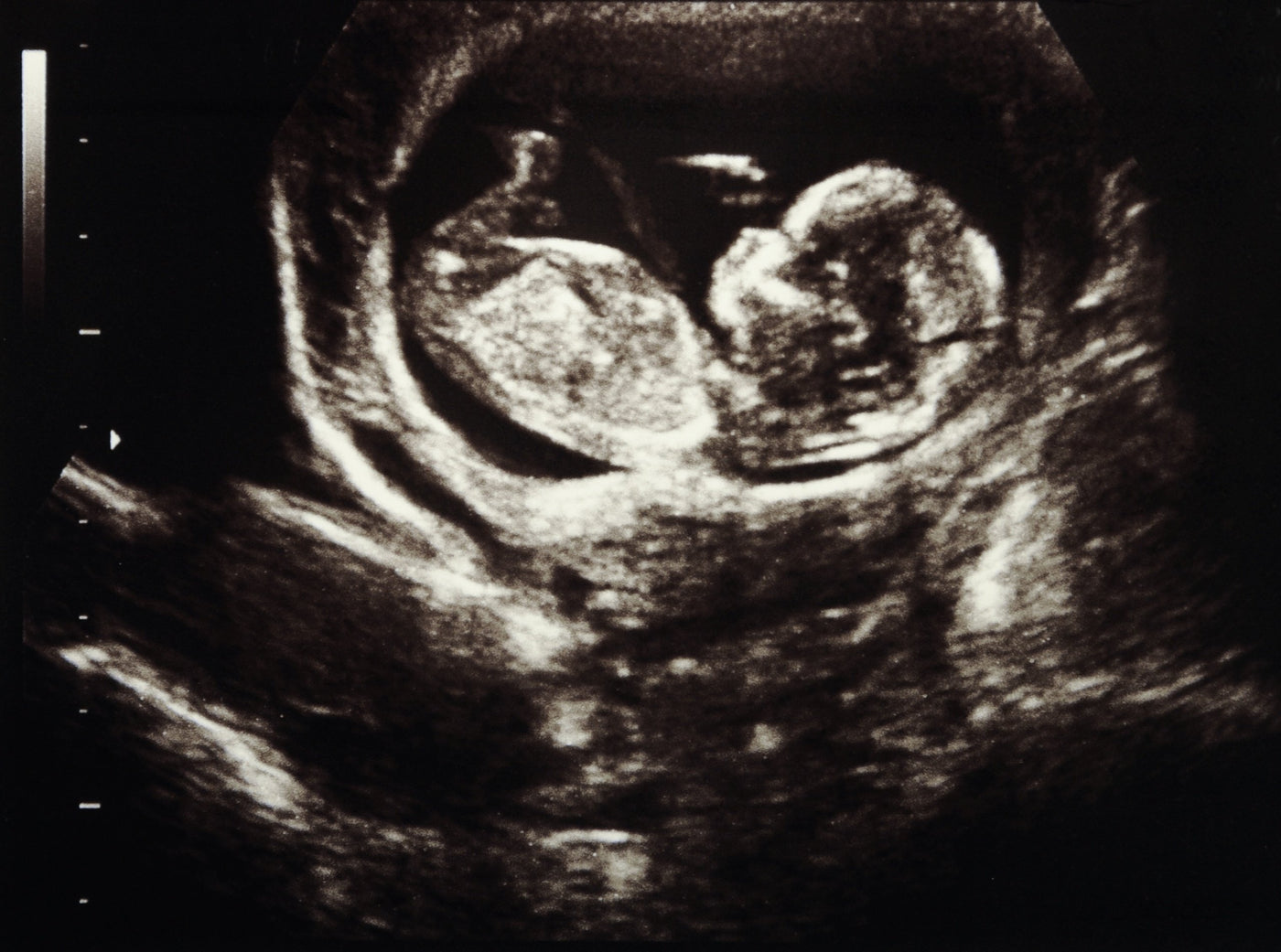 Dank Ultraschall ist es möglich zu sehen, wie Ihr Baby während der Schwangerschaft wächst. Ist es schädlich?